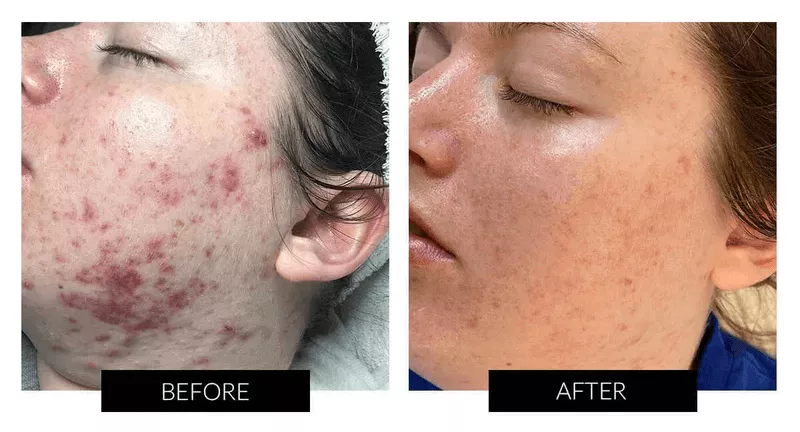 Dermalux フレックス MD